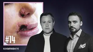 ENG SUB. Failed lip augmentation. Necrosis, hematoma. HIT-FUCKUP / KAMINSKY