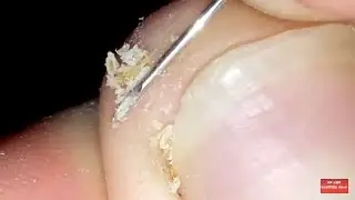 How to clean in depth lateral toenail fold #12