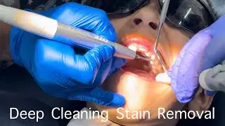 How Teeth Are Cleaned At The Dentist Live 🔴