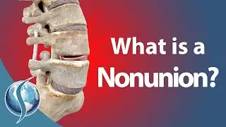 What is a Nonunion?