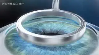 ผ่าตัดแก้ไขสายตาผิดปกติด้วยเลเซอร์ : Photorefractive Keratectomy (PRK)