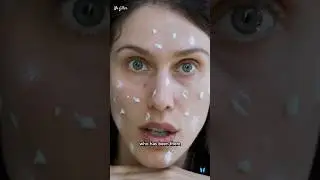 Yes, I’m an esthetician with acne. People say, “I’d never take advice form you” ❤️ 