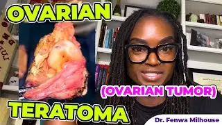 OVARIAN TORSION | TWISTED OVARY | Dr. Milhouse