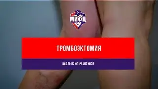 Тромбоэктомия (видео из операционной)