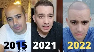 Te cuento todo mi proceso capilar // INJERTO de PELO + MICROPIGMENTACIÓN CAPILAR
