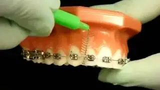 Bracesquestions.com - Brushing With Braces, How to Brush Teeth