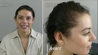 Micropigmentation des Cheveux pour Femme