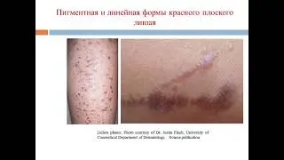 Красный плоский лишай
