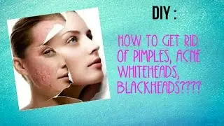 How to get rid of pimples,acenes,whiteheads,blackheads😀😀