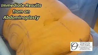 Immediate Results after a Tummy Tuck| Orange County Plastic Surgery #plasticsurgeryresults