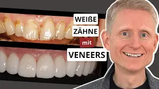 Für JEDEN machbar - Schöne weiße Zähne mit dieser Strategie (2023)