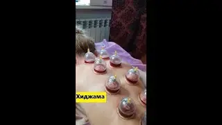 🌡Хиджама - что это такое?