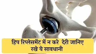 अगर कूल्हा ख़राब हो गया हो तो हिप रेप्लेस्मेंट करवाने में देरी ना करे । / hip replacement dr
