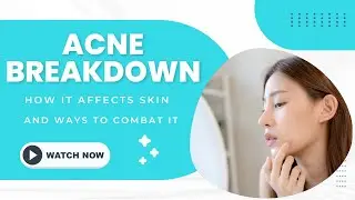 Acne Breakdown: How it Affects Skin and Ways to Combat It