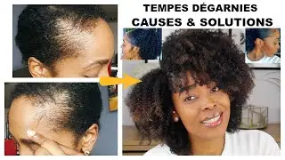 Comment J'ai Fait POUSSER mes TEMPES DÉGARNIES RAPIDEMENT |  Photos Avant- Après + Produits Utilisés