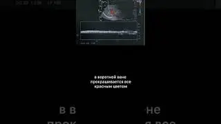 #воротная вена #асцит #узи