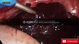 laproscopic surgery for ruptured ectopic with hugh blood loss