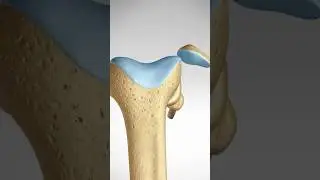 What happens when you dislocate your Knee Cap (MPFL Tears and Reconstruction) 