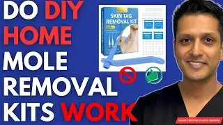 Is At Home Mole Removal Kits & DIY Effective? (no, here's why)