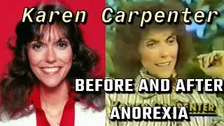 Karen Carpenter: Before & After Anorexia