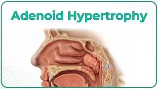 Adenoid Hyperthropy 🦠 : ENT Lectures