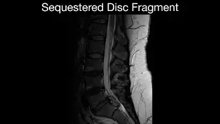 Sequestered Disc Fragment
