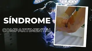 Síndrome compartimental - Prevención, diagnóstico y manejo