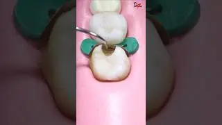 Perfect Cavity Filling 