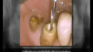 Caso_DrNolken.avi