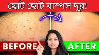🟢 ফাংগাল একনি থেকে মুক্তির উপায়! | Fungal Acne & Small Bumps Treatment