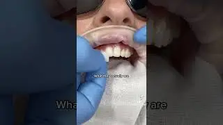 Quick Guide: Introduction to Veneers
