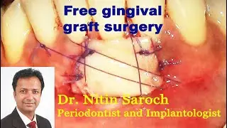 Free Gingival Graft (FGG) surgery