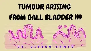 TUMOURS ARISING FROM GALL BLADDER  II SYSTEMIC PATHOLOGY II ROBBINS