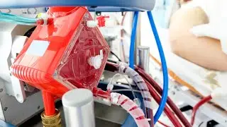 Percutaneous Insertion and Removal Technique of Bio-Medicus Cannula as SVC Cannula for CPB