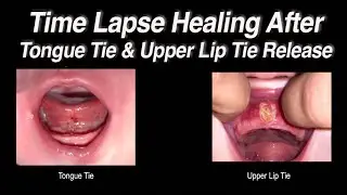 Healing Time Lapse After Tongue Tie and Upper Lip Tie Release