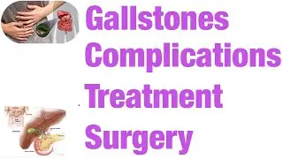 Gallbladder లో stones వస్తే ఏమి చెయ్యాలి/complications of gallbladder stones,treatment