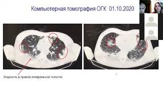 Клинический разбор: Пациент с инфекционным эндокардитом