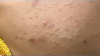 Remove hidden acne on the jaw (Nở P1) 