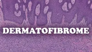LE DERMATOFIBROME – PATHOLOGIE