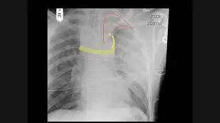 Why the apical cap appears on chest x-rays