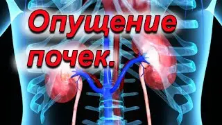 Опущение почки .Связь с осанкой.