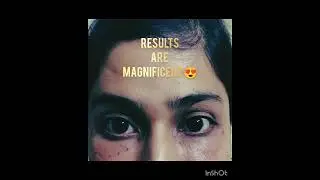 FAT TRANSFER FOR UNDEREYE HOLLOWNESS CORRECTION