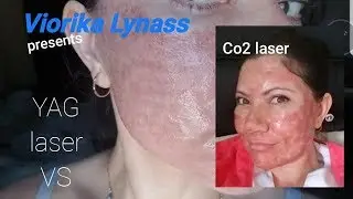 Look what happens when you do Yag Laser treatment (fractional) part 1