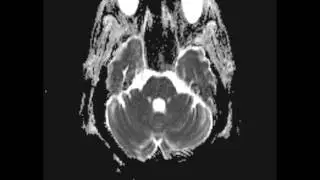 Persistent Trigeminal Artery