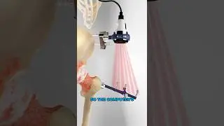 Computer assisted hip surgery (3D Animation)