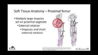 Subtrochanteric femoral fractures - 1 of 3