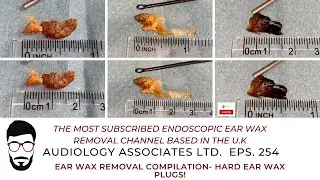 EAR WAX REMOVAL COMPILATION - HARD EAR WAX PLUGS - EP 254