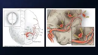 Treatment of a Ruptured Mycotic Middle Cerebral Artery Aneurysm with Excision and Reanastomosis