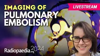 Imaging of Pulmonary Embolism with Sally Ayesa