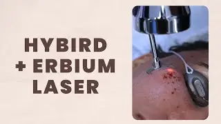 I WANT BABY SMOOTH SKIN WITHOUT ACNE SCARS  | HYBIRD + ERBIUM LASER | PATIENT STORY | Dr. Jason Emer